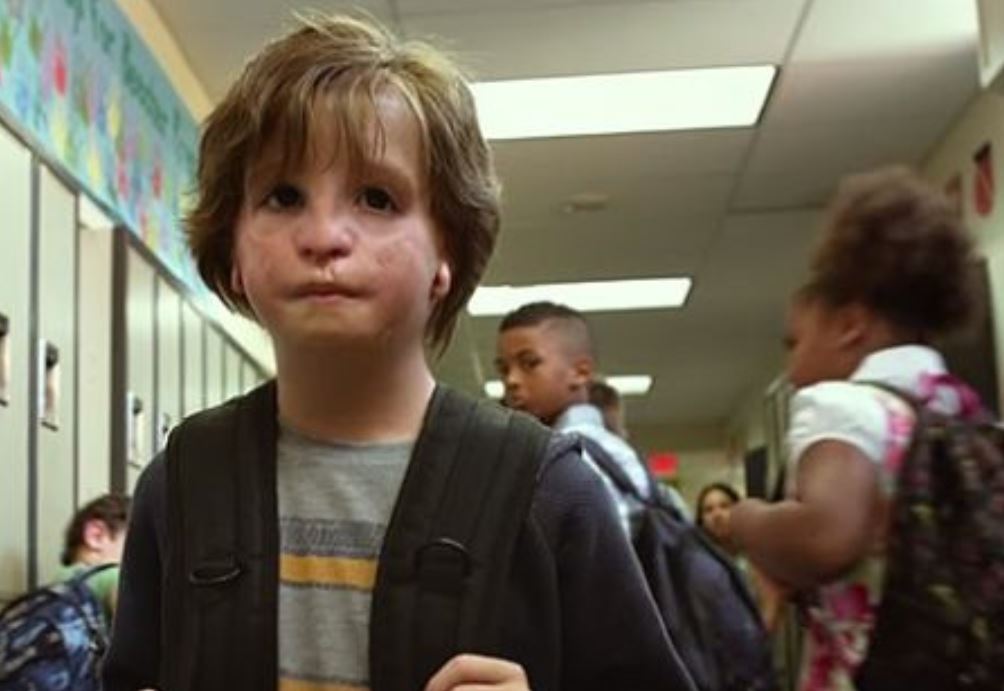Ein Junge mit auffälligen Veränderungen im Gesicht geht durch den Flur seiner Schule.